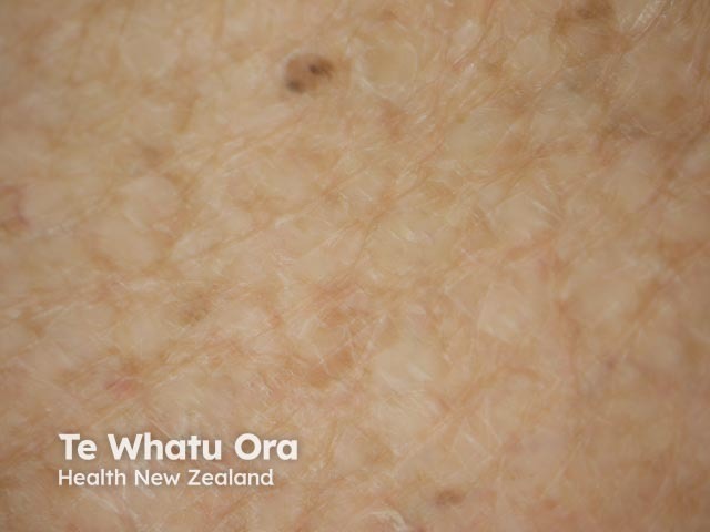 Ichthyosis vulgaris