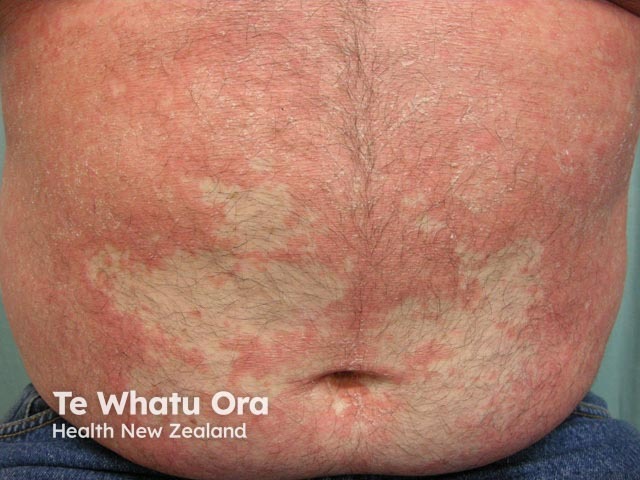 Pityriasis rubra pilaris