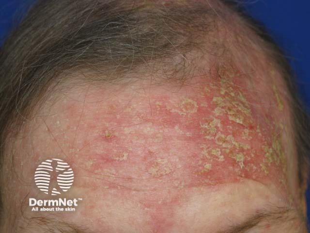 Sebopsoriasis of forehead