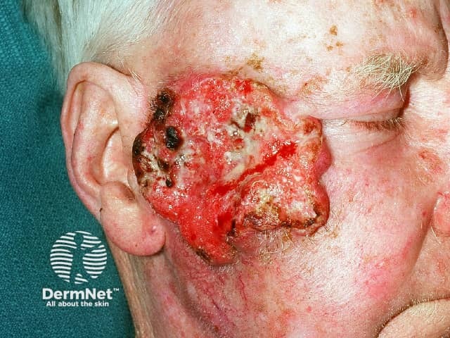 An advanced SCC on the cheek that has already spread to the local lymph nodes