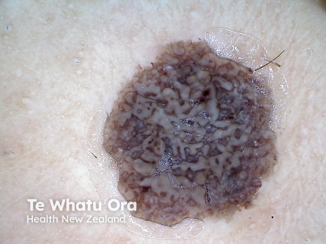 Seborrhoeic keratosis, nonpolarised dermoscopy view