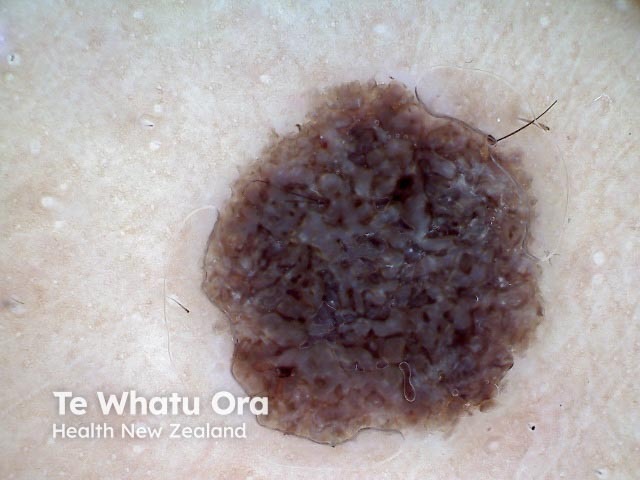 Seborrhoeic keratosis, polarised dermoscopy view