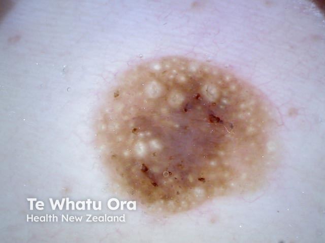 Seborrhoeic keratosis, nonpolarised dermoscopy view