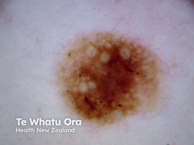 Seborrhoeic keratosis, polarised dermoscopy view