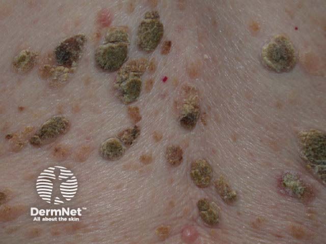 Seborrhoeic keratosis