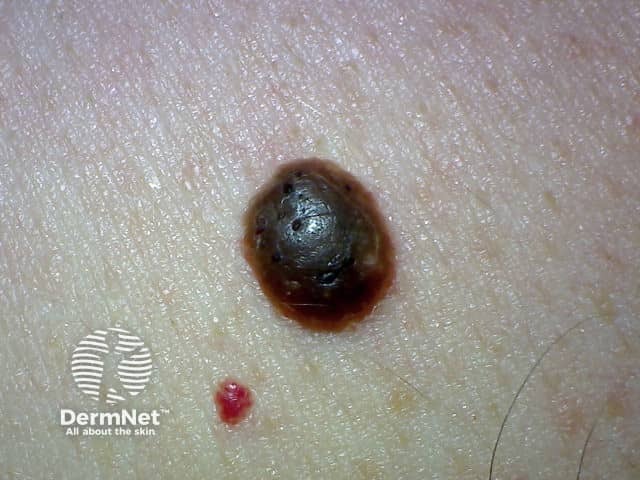 Seborrhoeic keratosis