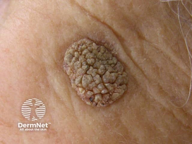 Seborrhoeic keratosis