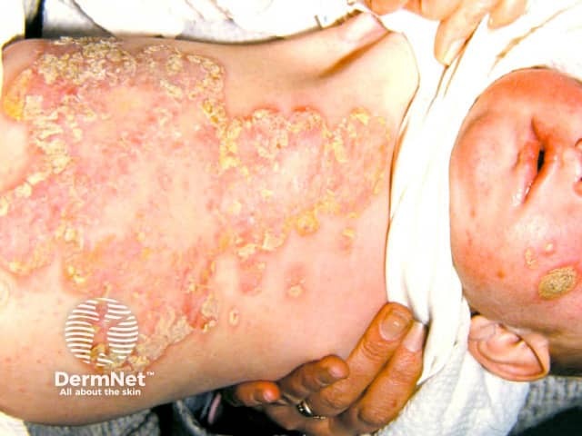 Widespread impetigo