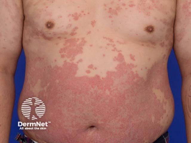 Severe psoriasis