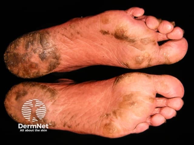 Plantar keratoderma in Sézary syndrome