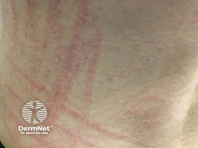 Shiitake flagellate erythema