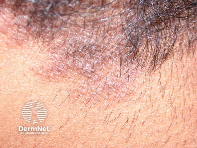 Atopic dermatitis of scalp