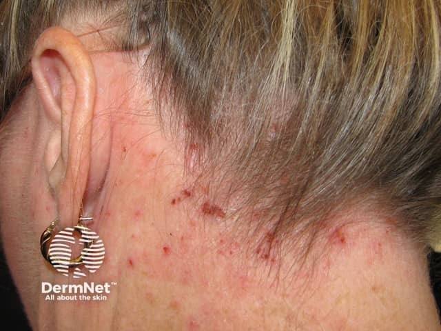 Atopic dermatitis of scalp