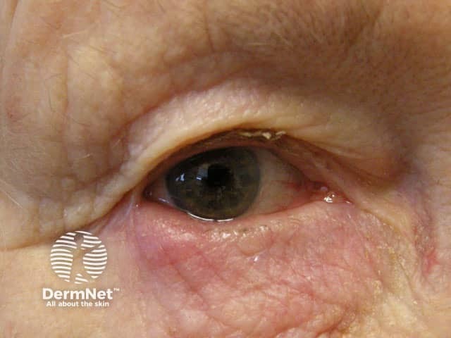 Blepharitis due to rosacea