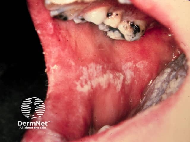 Oral candidiasis