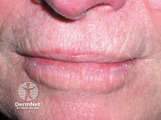 Actinic cheilitis