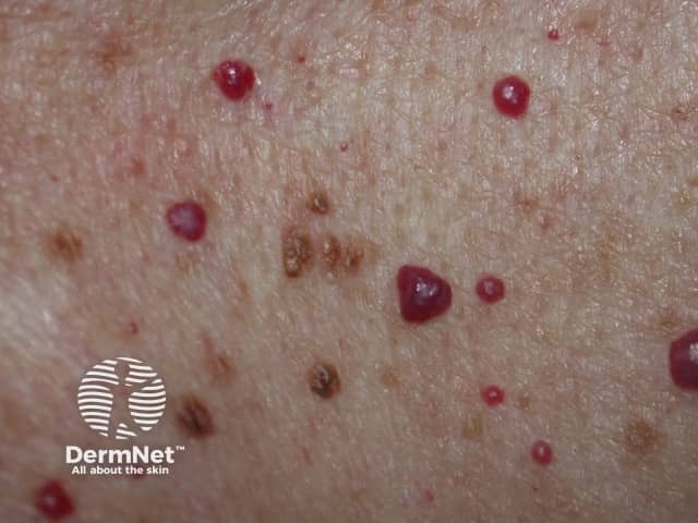 Cherry angiomas