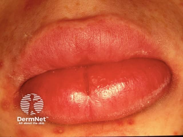 Granulomatous cheilitis