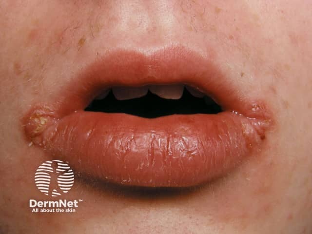 Granulomatous cheilitis