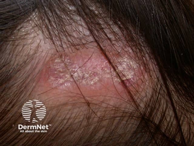 Discoid lupus erythematosus of scalp