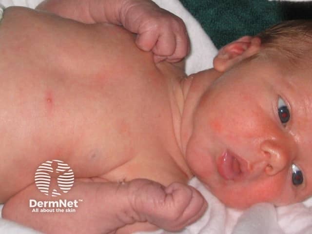 Toxic erythema of the newborn