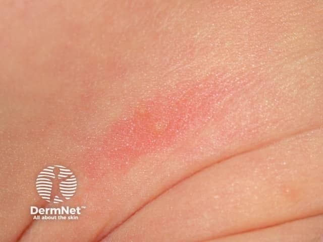 Toxic erythema of the newborn