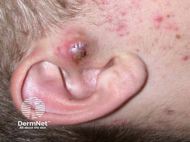 Acne cyst