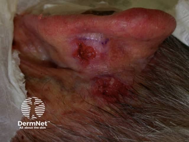 Ulcerated basal cell carcinoma