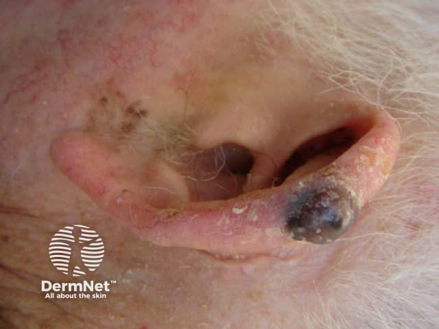 Nodular melanoma