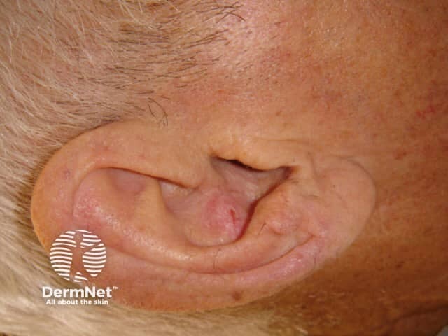 Nodular basal cell carcinoma