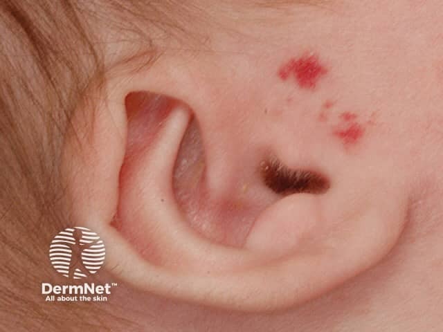 Infantile haemangioma