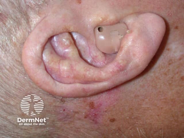 Squamous basal cell carcinoma