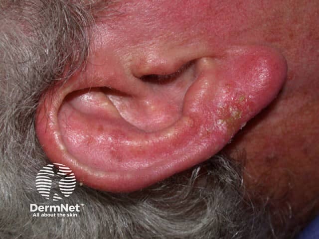 Squamous basal cell carcinoma