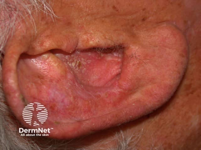 Squamous cell carcinoma in situ