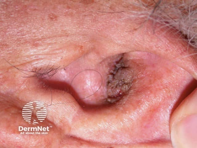 Seborrhoeic keratosis