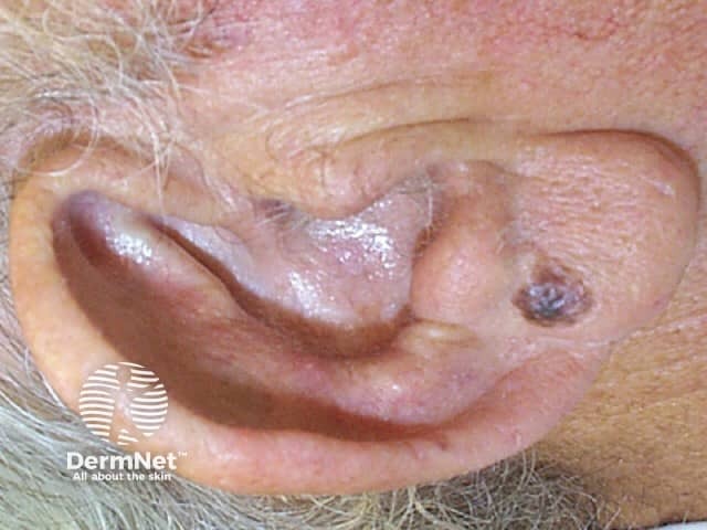 Superficial spreading melanoma