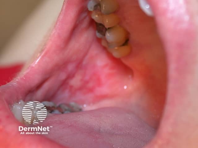 Erosive oral lichen planus