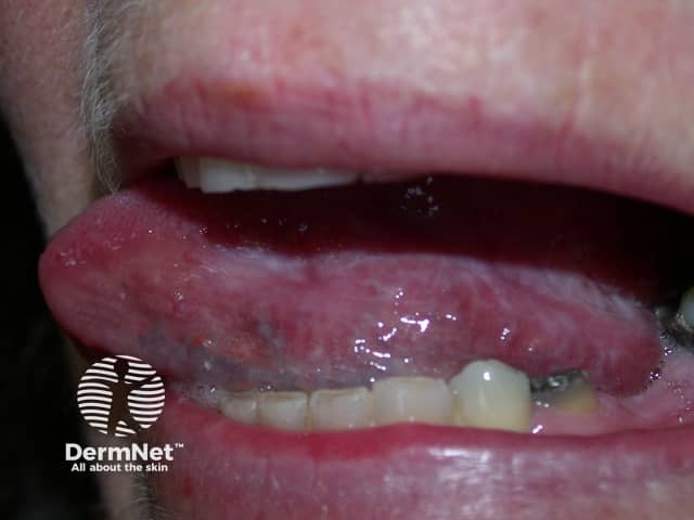 Erosive oral lichen planus