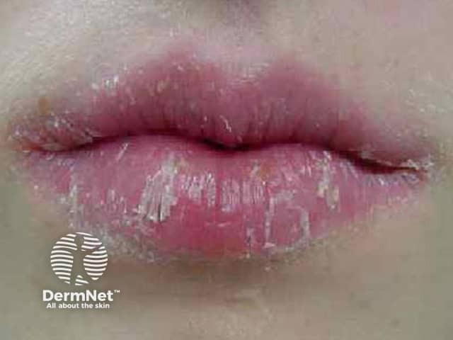 Exfoliative cheilitis