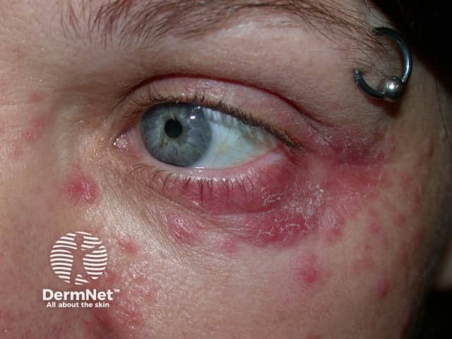 Periocular/periorificial dermatitis