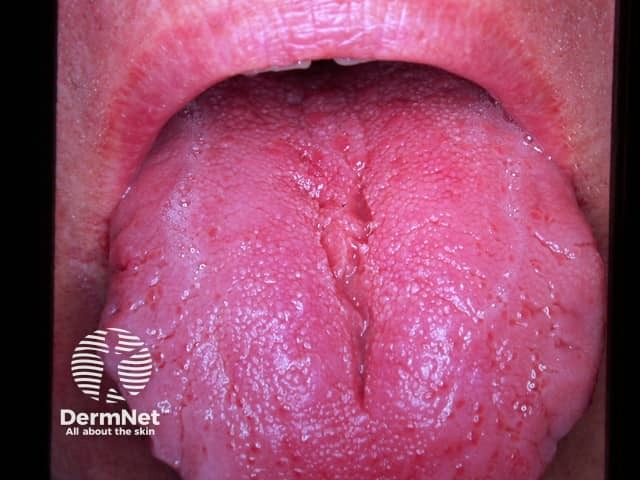 Fissured tongue