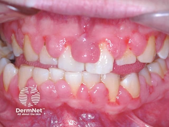 Gingival enlargement