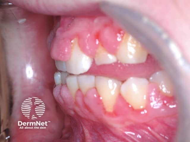 Gingival enlargement