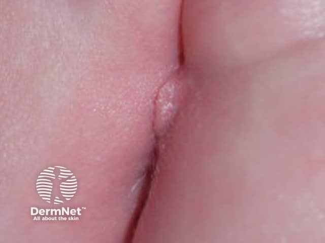 Perineal pyramidal protrusion