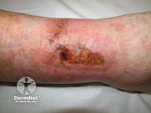 Leg ulcer