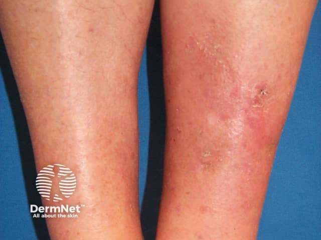 Pretibial myxoedema