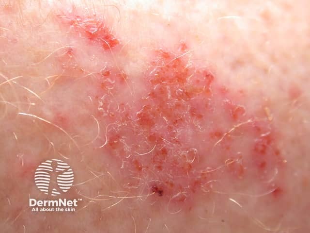 Discoid eczema