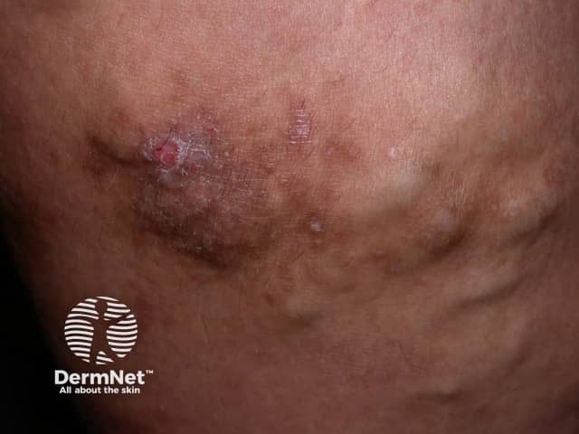 Varicose dermatitis