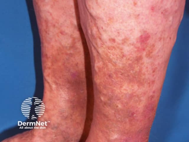 Gravitational dermatitis