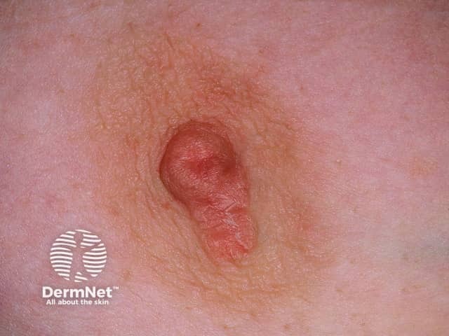 Nipple eczema